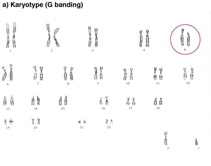 5p-
          karyotype