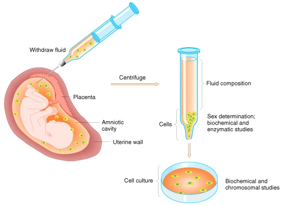 Amniocentesis