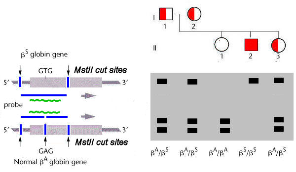 sickle cell electrophoresis