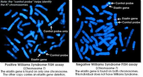 Williams Syndrome FISH karyotype