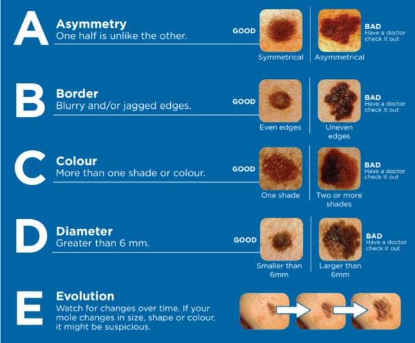 Images of good and bad things to look for when examining the skin for signs of skin cancer
