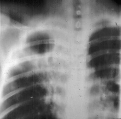 Chest xray taken at Nain in winter 1966-67